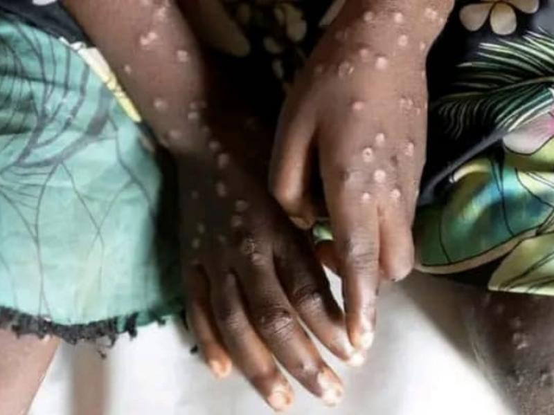 Mpox