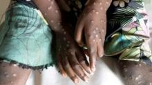Mpox